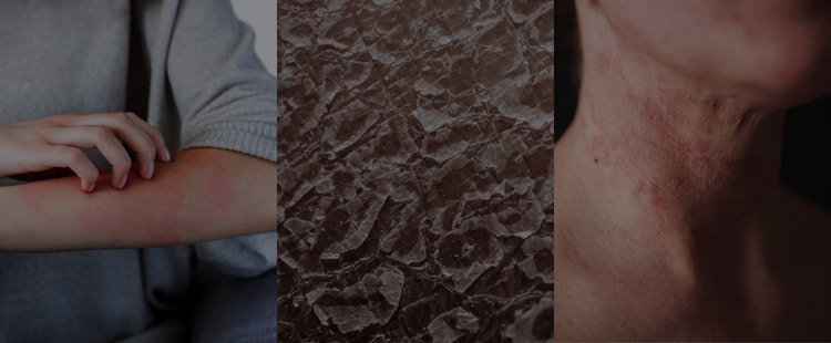 異位性皮膚炎的嚴重程度